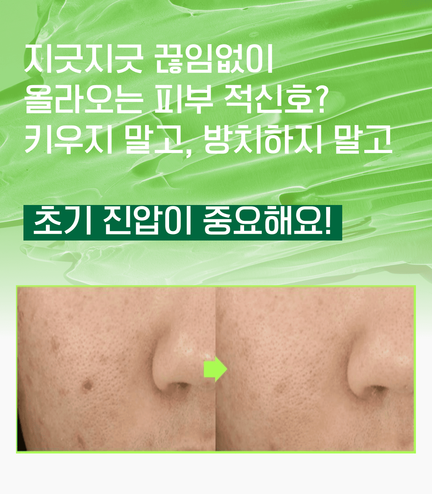 Troubless 클리어 젤 크림 (스팟) 15ml